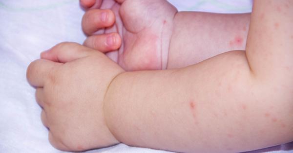 Herpes en bebés: el beso inocente que puede ser mortal