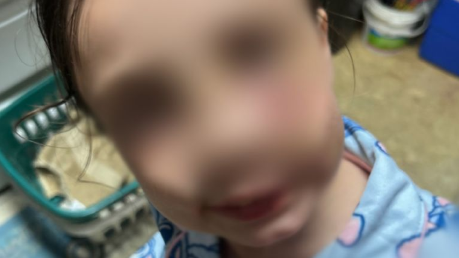 Ataque brutal de un pastor australiano azul a niña de 9 años en Alabama