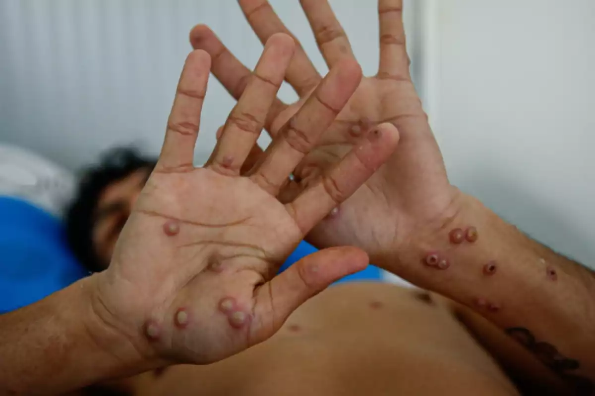 Fallece joven en Cancún por Mpox y graves complicaciones de salud