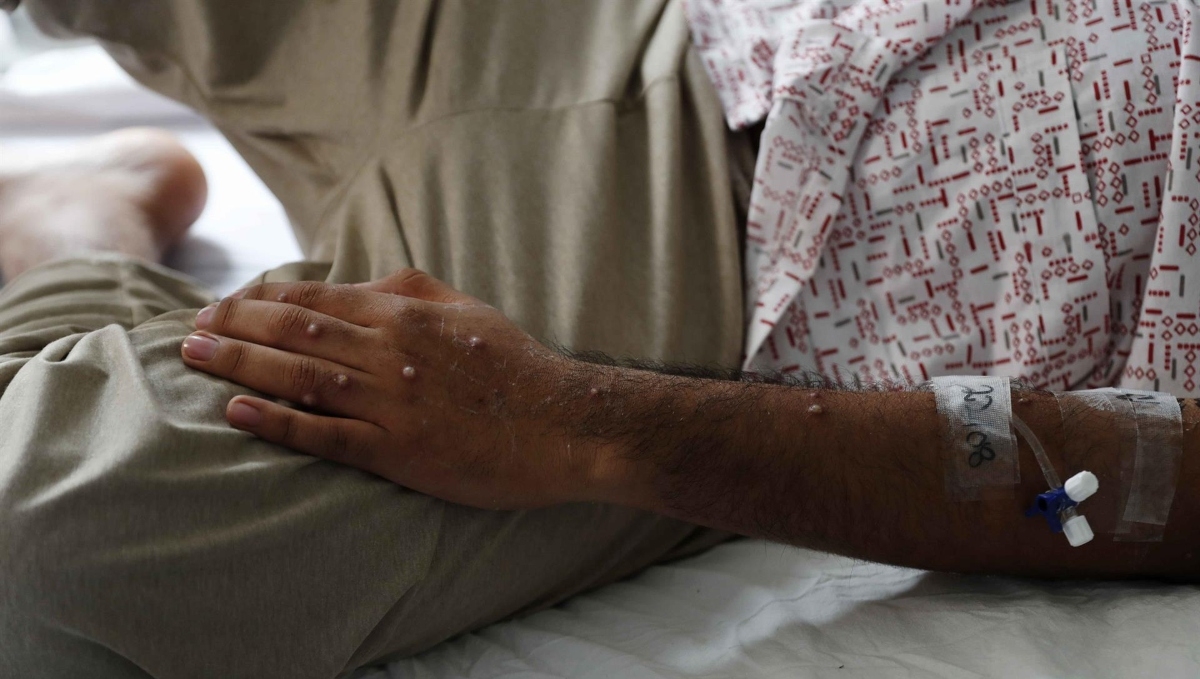 Chiapas confirma caso de mpox en Tuxtla Gutiérrez