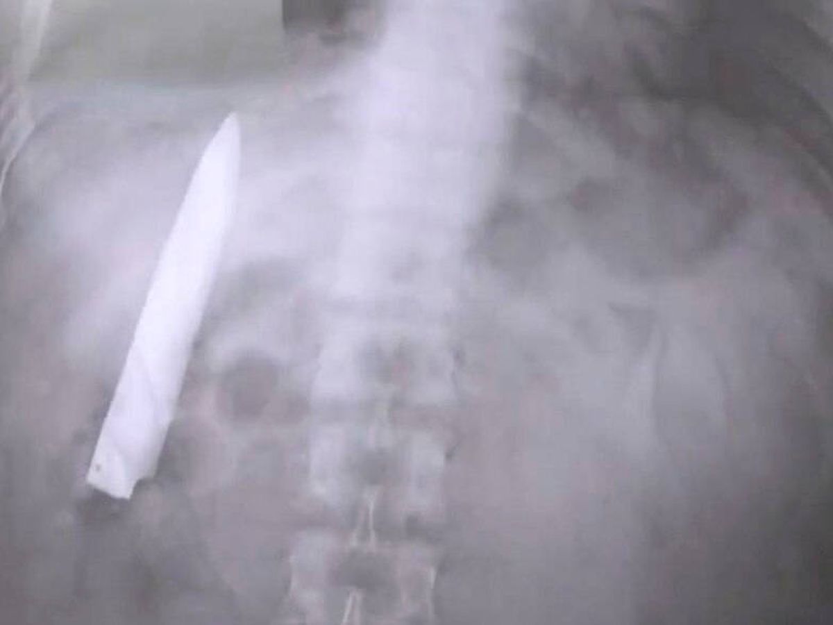 Sorprendente hallazgo: Hombre vivió una década con un cuchillo en el pecho